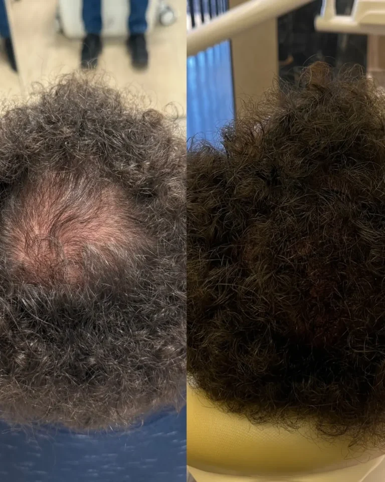 Resultado antes e depois na clínica Jaque Vaz Estética e Saúde em Guarapuava PR