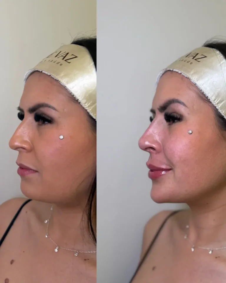 Resultado antes e depois na clínica Jaque Vaz Estética e Saúde em Guarapuava PR