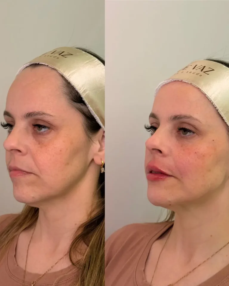 Resultado antes e depois na clínica Jaque Vaz Estética e Saúde em Guarapuava PR