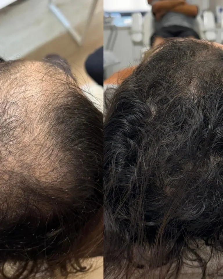 Resultado antes e depois na clínica Jaque Vaz Estética e Saúde em Guarapuava PR