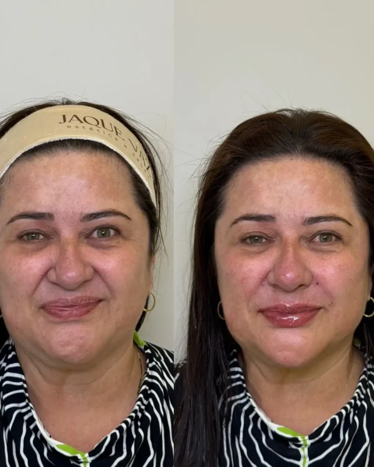 Resultado antes e depois na clínica Jaque Vaz Estética e Saúde em Guarapuava PR