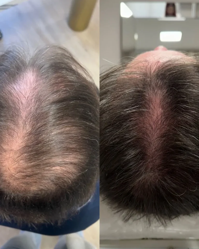 Resultado antes e depois na clínica Jaque Vaz Estética e Saúde em Guarapuava PR