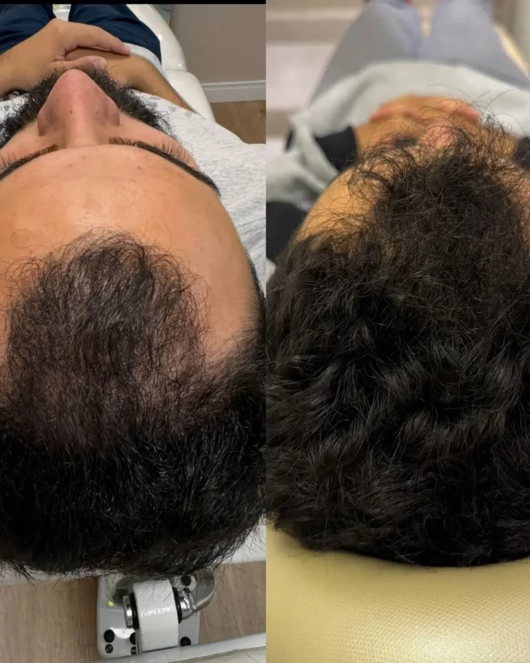 Resultado antes e depois na clínica Jaque Vaz Estética e Saúde em Guarapuava PR