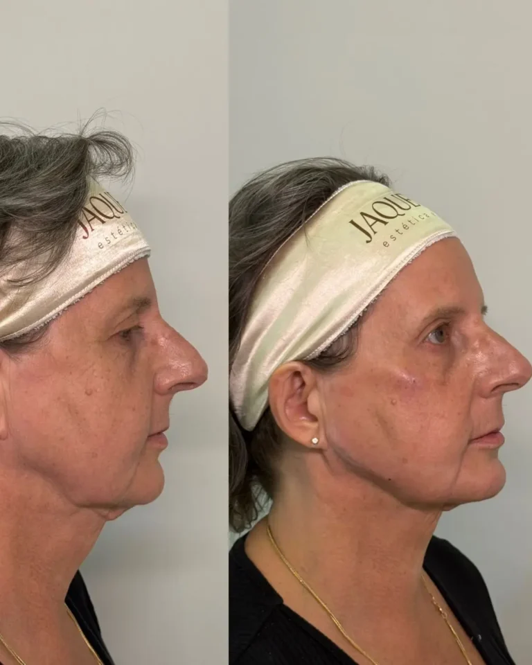 Resultado antes e depois na clínica Jaque Vaz Estética e Saúde em Guarapuava PR