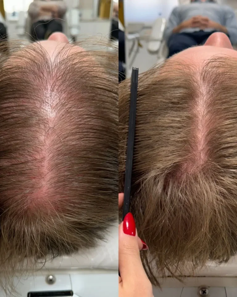 Resultado antes e depois na clínica Jaque Vaz Estética e Saúde em Guarapuava PR