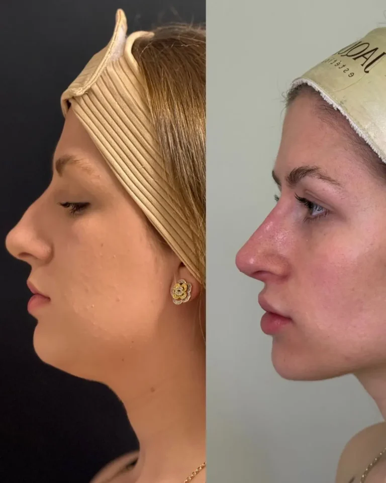 Resultado antes e depois na clínica Jaque Vaz Estética e Saúde em Guarapuava PR