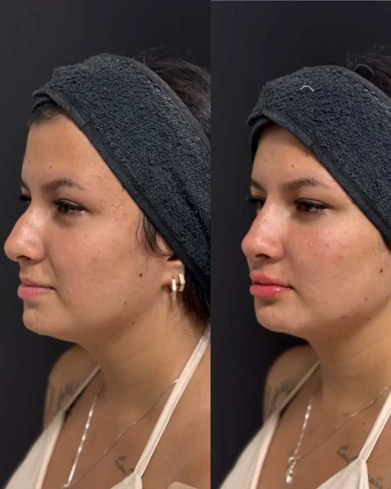 Resultado antes e depois na clínica Jaque Vaz Estética e Saúde em Guarapuava PR