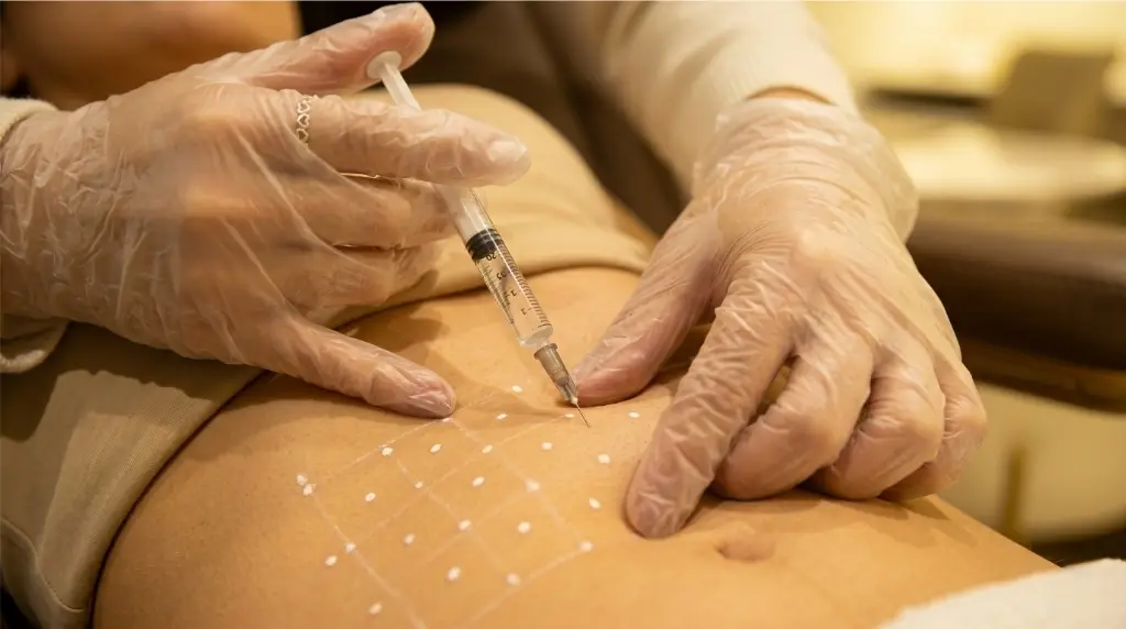Aplicação de enzimas para gordura localizada na região do abdômen com seringa e marcações na pele na clínica Jaque Vaz Estética e Saúde em Guarapuava PR