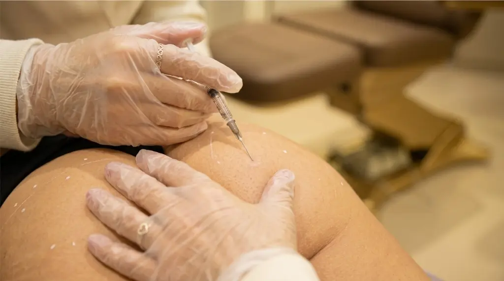 Harmonização glútea com aplicação injetável de seringa com marcações na pele na clínica Jaque Vaz Estética e Saúde em Guarapuava PR